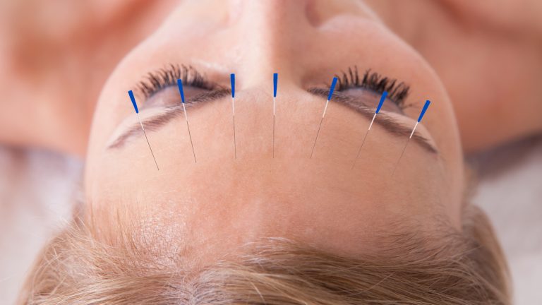 How Can Acupuncture Help You
